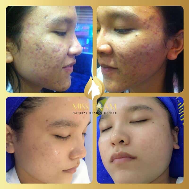 Photos quality acne treatment results at hcm in Miss Tram Spa
