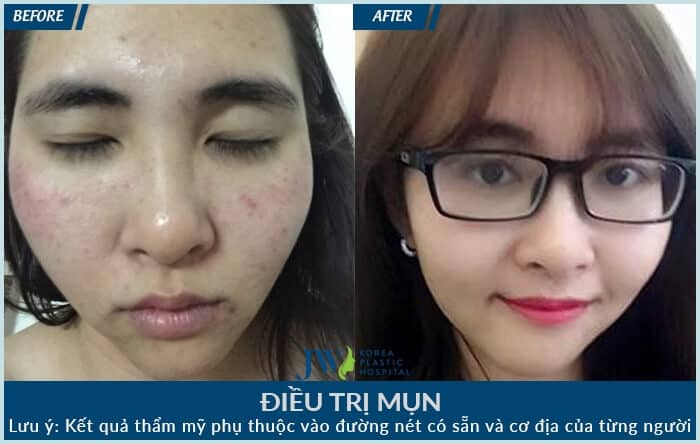 Korean salon JW is a safe spa treatment for acne in hcm