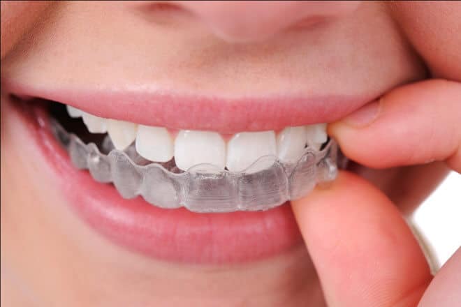- Top 5 Dental Clinics with Low Cost Braces Without Braces in Ho Chi Minh City