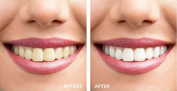 - Top 5 Prestigious and Quality Teeth Whitening Address in City. Ho Chi Minh