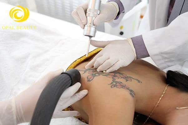 - Top 3 Most Prestigious Scarless Tattoo Removal Address in Binh Thanh District