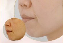 - Top 6 Địa Chỉ Điều Trị Nám Triệt Để Tại Quận Bình Thạnh Và Phú Nhuận