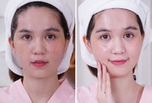 - Top 6 Địa Chỉ Xóa Nám Hiệu Quả Nhất Quận 1