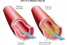 - Top 12 Thực Phẩm Giảm Nguy Cơ Xơ Vữa Động Mạch