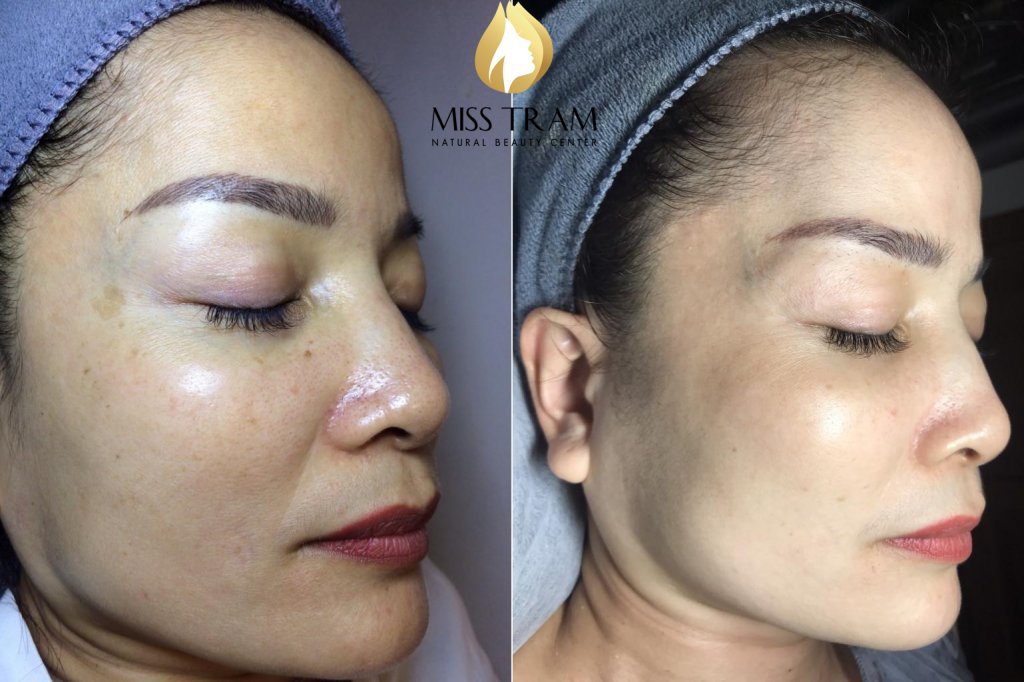 The most effective service to remove melasma and freckles at miss tram hcm