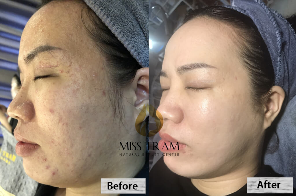 Spa services for Deep Scars - Pimples - Acne Scars