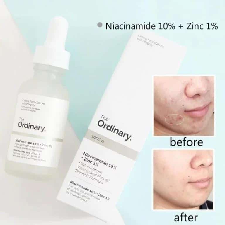 Top effective acne serums
