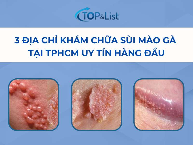 3 Địa chỉ khám chữa sùi mào gà tại TPHCM - 3 Địa Chỉ Khám Chữa Sùi Mào Gà Tại TPHCM Uy Tín Hàng Đầu 3 Địa chỉ khám chữa sùi mào gà tại TPHCM