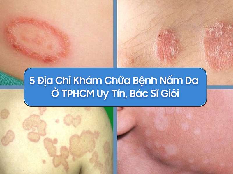 5 Địa chỉ khám chữa bệnh nấm da ở TPHCM - 5 Địa Chỉ Khám Chữa Bệnh Nấm Da ở TPHCM Uy Tín, Bác Sĩ Giỏi 5 Địa chỉ khám chữa bệnh nấm da ở TPHCM
