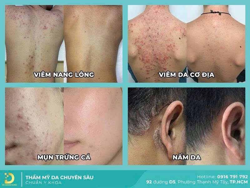 Điều trị da liễu tại Dr. Choice Clinic - Top 5 Địa Chỉ Khám Da Liễu Tại TPHCM Tốt Và Uy Tín Nhất Điều trị da liễu tại Dr. Choice Clinic