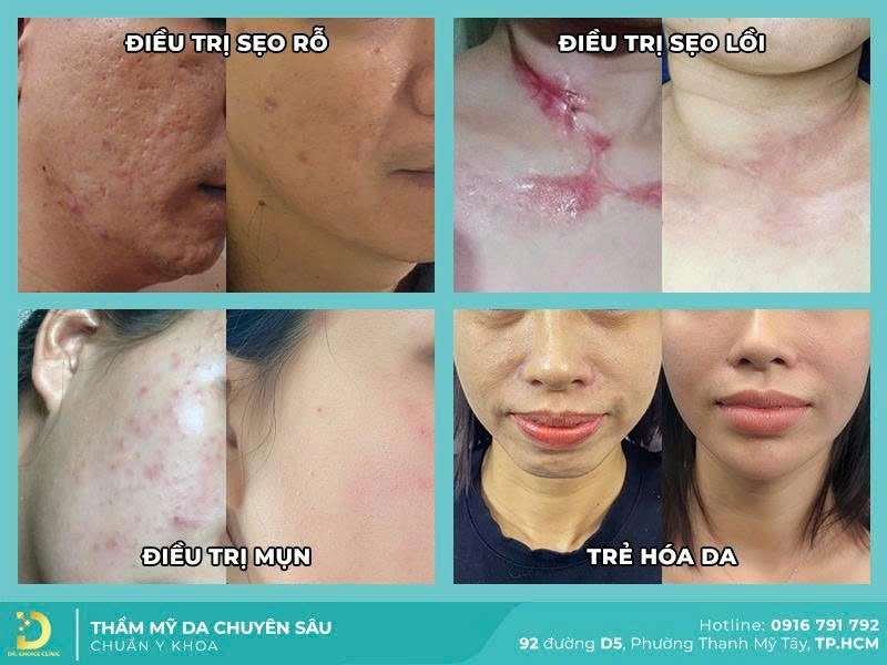 Điều trị, chăm sóc thẩm mỹ da tại Dr. Choice Clinic - 3 Địa Chỉ Khám Chữa Sùi Mào Gà Tại TPHCM Uy Tín Hàng Đầu Điều trị, chăm sóc thẩm mỹ da tại Dr. Choice Clinic