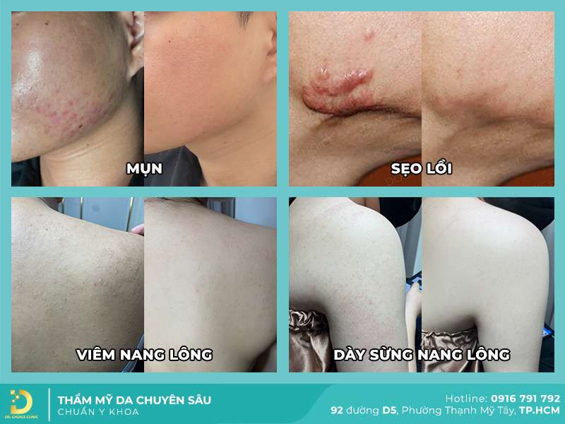 Điều trị da liễu, thẩm mỹ da hiệu quả tại Dr. Choice Clinic HCM - Top 3 Địa Chỉ Khám Chữa Vảy Nến Tại TPHCM Có Bác Sĩ Giỏi Điều trị da liễu, thẩm mỹ da hiệu quả tại Dr. Choice Clinic HCM