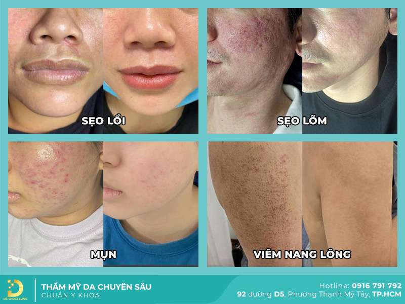 Điều trị da liễu, thẩm mỹ da tại Dr. Choice Clinic - Top 3 Địa Chỉ Khám Viêm Da Cơ Địa Ở TPHCM Uy Tín, Bác Sĩ Giỏi Điều Trị Điều trị da liễu, thẩm mỹ da tại Dr. Choice Clinic