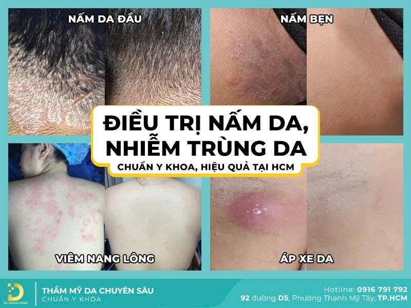 Điều trị nấm da, nhiễm trùng da tại Dr. Choice Clinic - 5 Địa Chỉ Khám Chữa Bệnh Nấm Da ở TPHCM Uy Tín, Bác Sĩ Giỏi Điều trị nấm da, nhiễm trùng da tại Dr. Choice Clinic