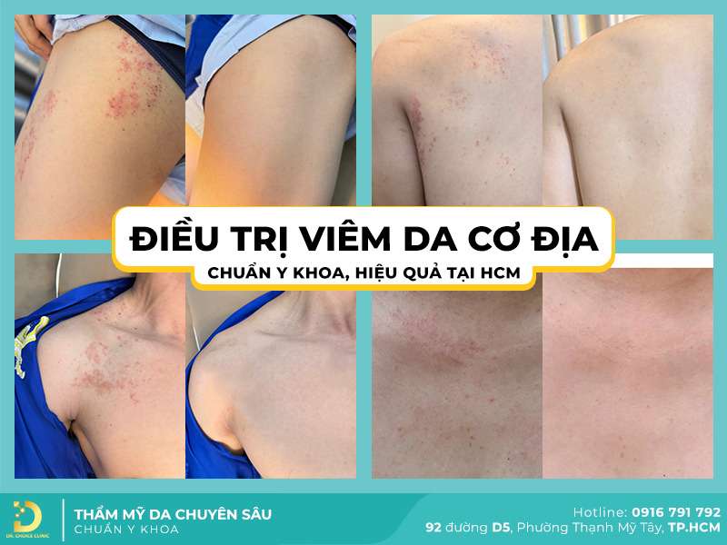 Điều trị viêm da cơ địa chuẩn y khoa tại Dr. Choice Clinic - Top 3 Địa Chỉ Khám Viêm Da Cơ Địa Ở TPHCM Uy Tín, Bác Sĩ Giỏi Điều Trị Điều trị viêm da cơ địa chuẩn y khoa tại Dr. Choice Clinic