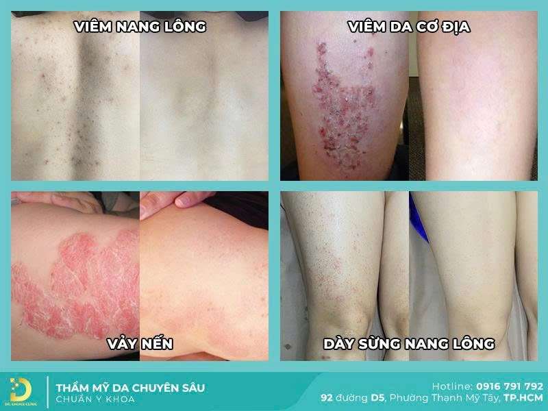 Dr. Choice Clinic chuyên điều trị các bệnh da liễu tại TPHCM - 3 Địa Chỉ Khám Chữa Sùi Mào Gà Tại TPHCM Uy Tín Hàng Đầu Dr. Choice Clinic chuyên điều trị các bệnh da liễu tại TPHCM