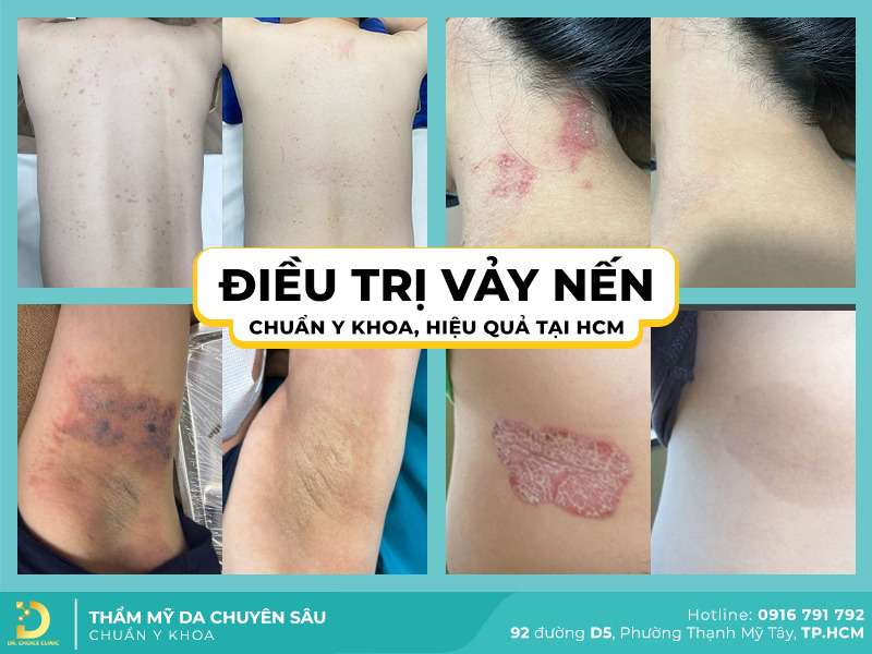 Dr. Choice Clinic chuyên điều trị các loại vảy nến hiệu quả - Top 3 Địa Chỉ Khám Chữa Vảy Nến Tại TPHCM Có Bác Sĩ Giỏi Dr. Choice Clinic chuyên điều trị các loại vảy nến hiệu quả