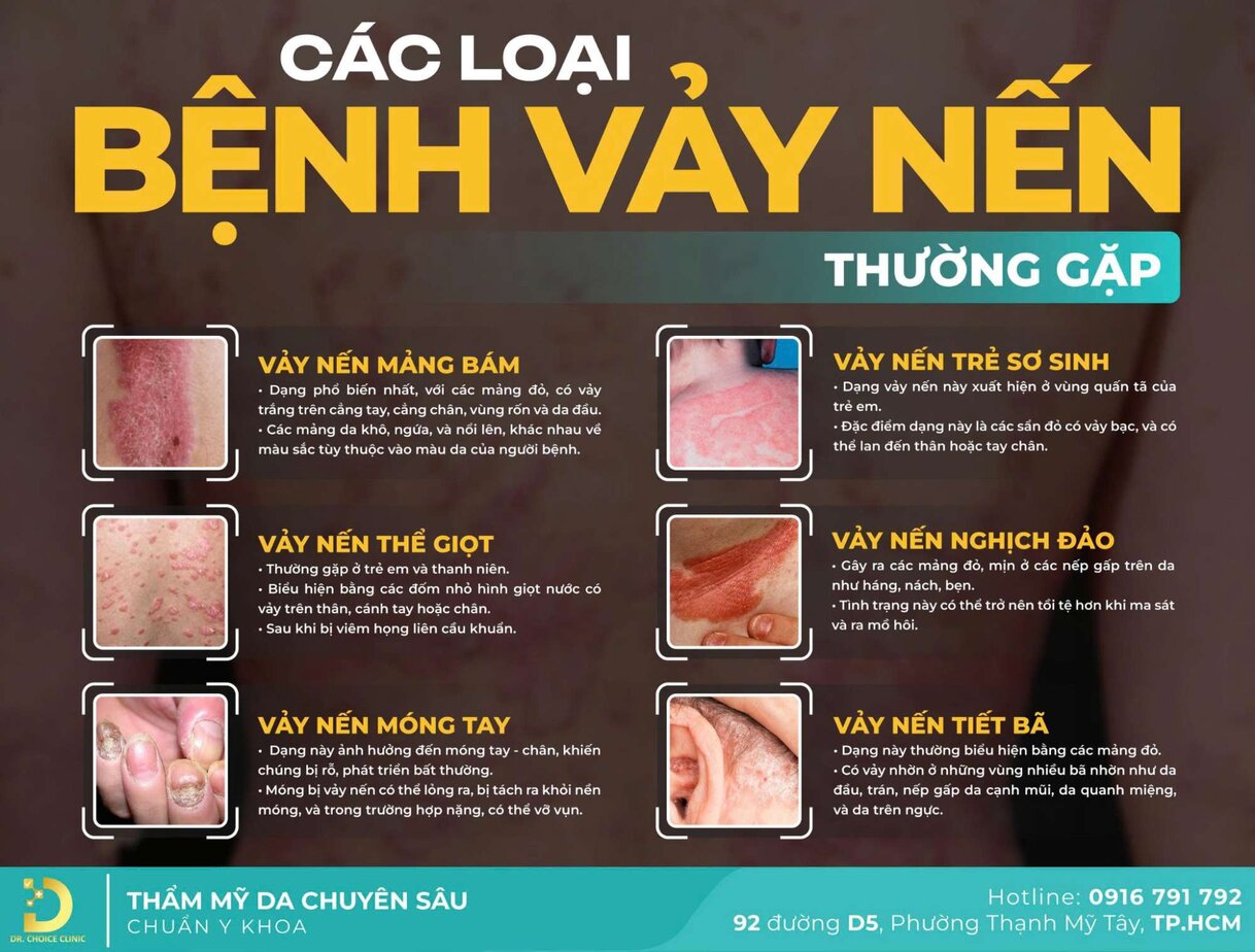 Dr. Choice Clinic chuyên điều trị các loại vảy nến khó trị - Top 3 Địa Chỉ Khám Chữa Vảy Nến Tại TPHCM Có Bác Sĩ Giỏi Dr. Choice Clinic chuyên điều trị các loại vảy nến khó trị